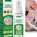Micostop Terapéutico Herbal Spray antifúngico natural para hongos en pies, manos y articulaciones