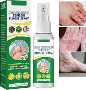 Micostop Terapéutico Herbal Spray antifúngico natural para hongos en pies, manos y articulaciones